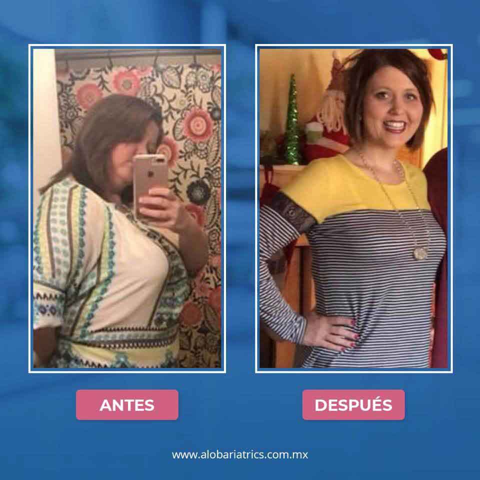 antes y después de cirugía bariátrica en Alo bariatrics México