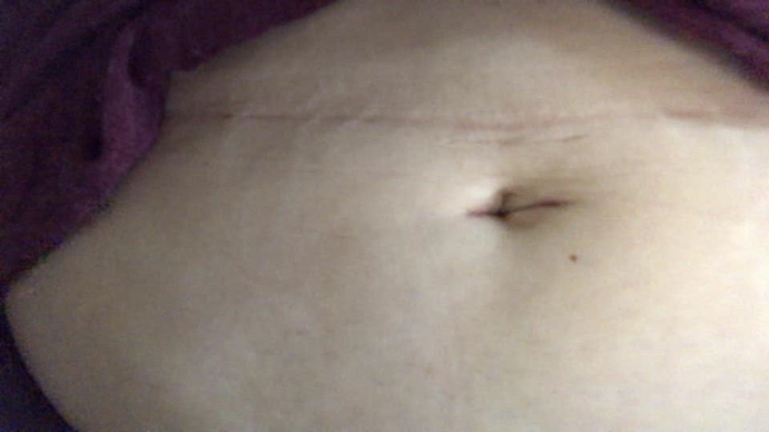 Cirugía laparoscópica de una sola incisión sin cicatrices visibles.