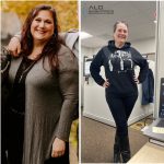 Resultados de antes y despues de cirugia de manga gastrica. Alo Bariatrics Tijuana Mexico